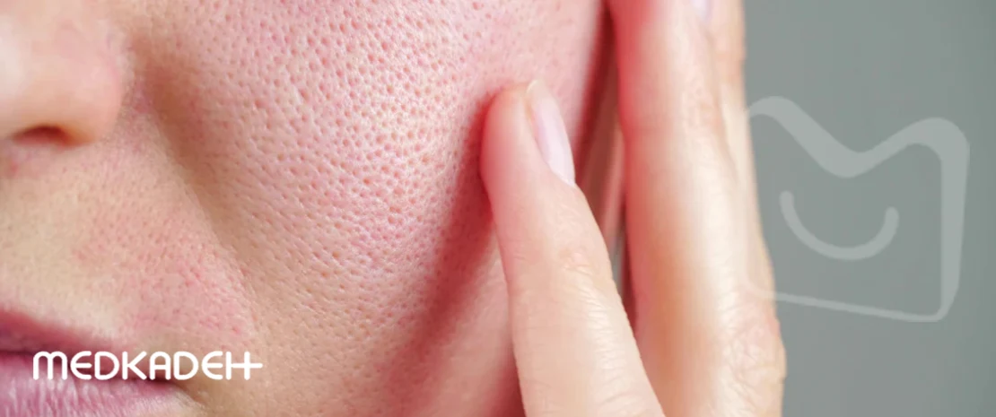 ماسک خانگی برای منافذ باز پوست صورت