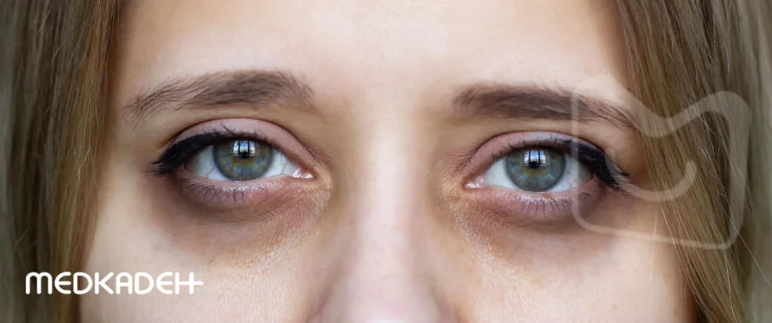 درمان خانگی سیاهی زیر چشم