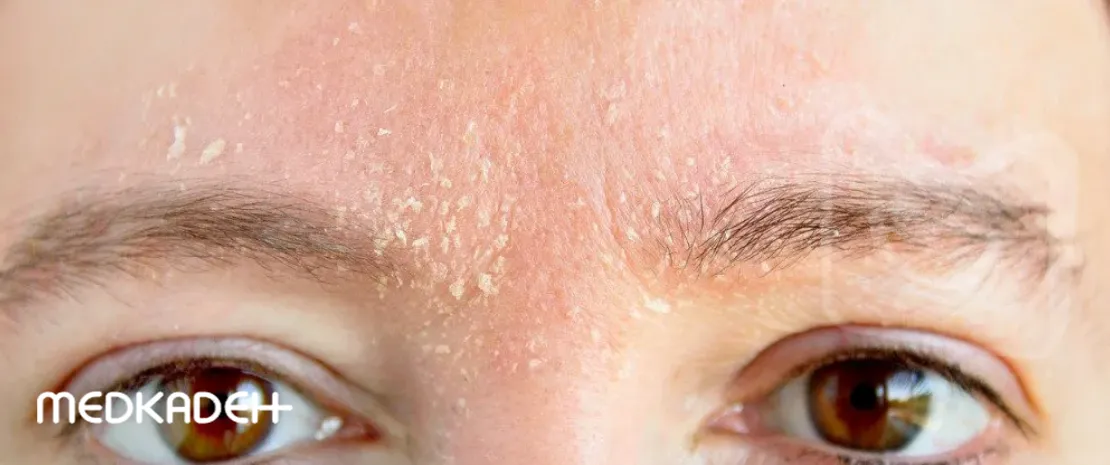 پوست دهیدراته چیست