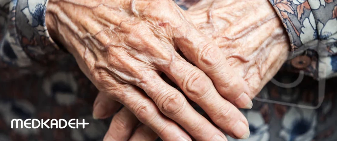 واریس دست چیست