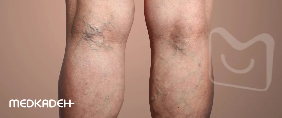 علت واریس پا در زنان