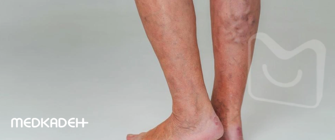 انواع واریس پا