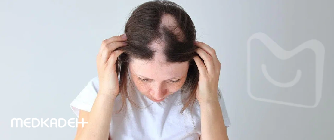 بیماری آلوپسی