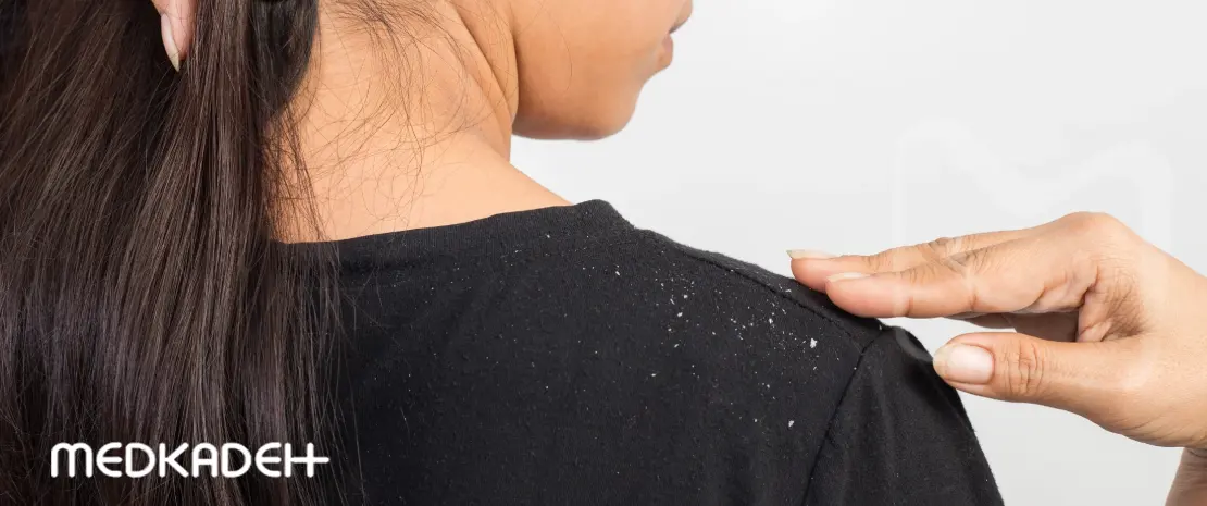 فرق شوره با پوسته سر