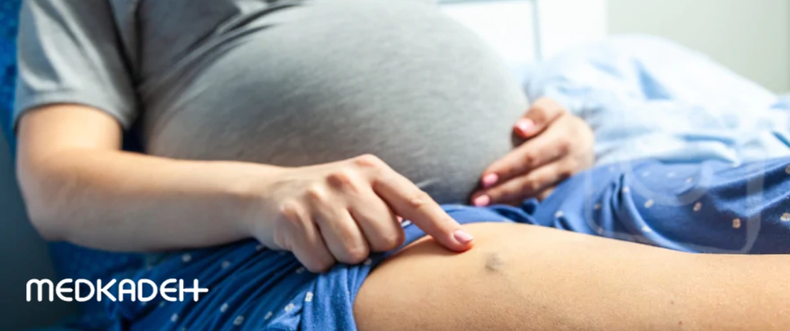 انواع واریس در بارداری