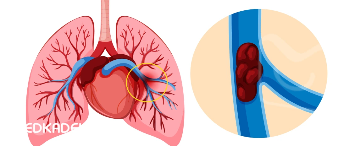 علائم آمبولی ریه